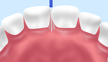 フロッシング（歯間清掃）