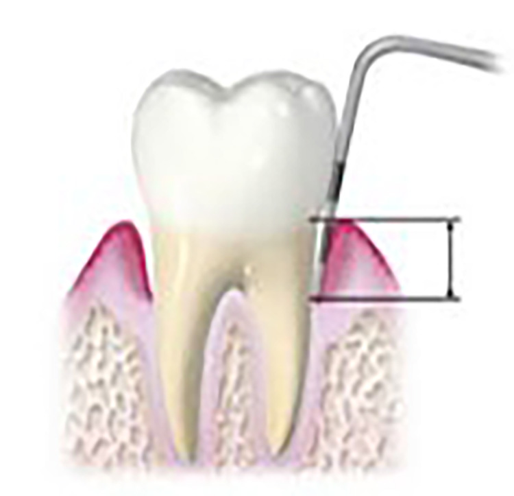 歯周病の検査（精密）