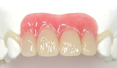 白いクラスプ義歯