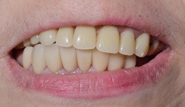 症例　「部分入れ歯（ノンクラスプ義歯）」の作り変え