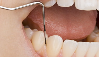2.　歯周病の検査（簡易）