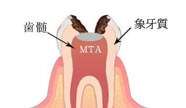 理由1　虫歯が進行しても神経を保存する 「MTAセメント法」