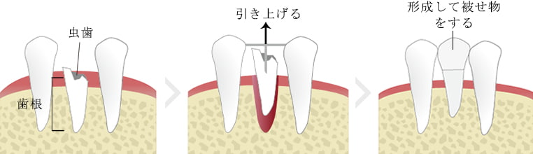 理由4　歯根だけになった歯は 「 エクストルージョン　（歯根廷出） 」