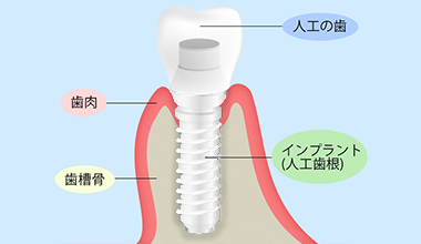 インプラント