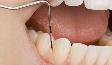 歯周病精密検査