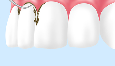 歯周病専用クリーニング